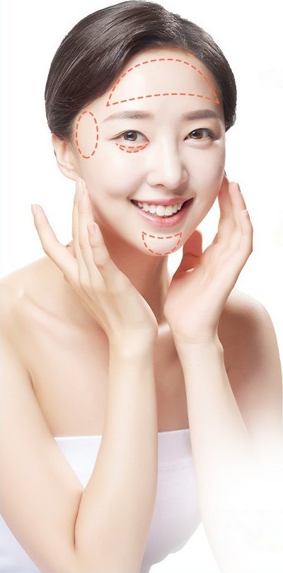 양손을 볼 옆에 대고 미소 짓는 여성 모델. 이마·관자놀이·눈 밑·턱끝에 필러 시술 범위가 주황 점선으로 표시돼 있다.