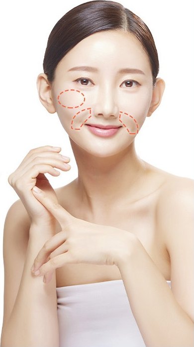 한 손을 가슴 앞에 모으고 정면을 보는 여성 모델. 옆 볼·팔자 주름·입가에 필러 시술 범위가 주황 점선으로 표시돼 있다.