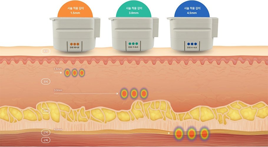 療程施打深度 1.5mm·3.0mm·4.5mm 探頭匣（DS 10-1.5 · DS 7-3.0 · DS 4-4.5）在表皮・真皮・脂肪・筋膜・肌肉剖面上，於各深度形成熱凝結點的分層拉提圖解