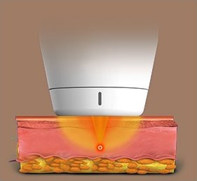 1.5mm 探頭緊貼皮膚、將熱能擴散至真皮層的剖面插圖